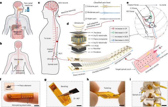 A programmable and self-adaptive ultrasonic wireless implant for personalized chronic pain management - Nature Electronics