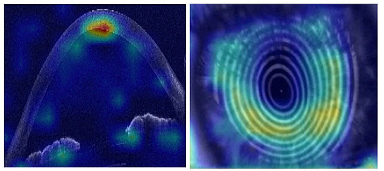 AI can spot which patients need treatment to prevent vision loss in young adults