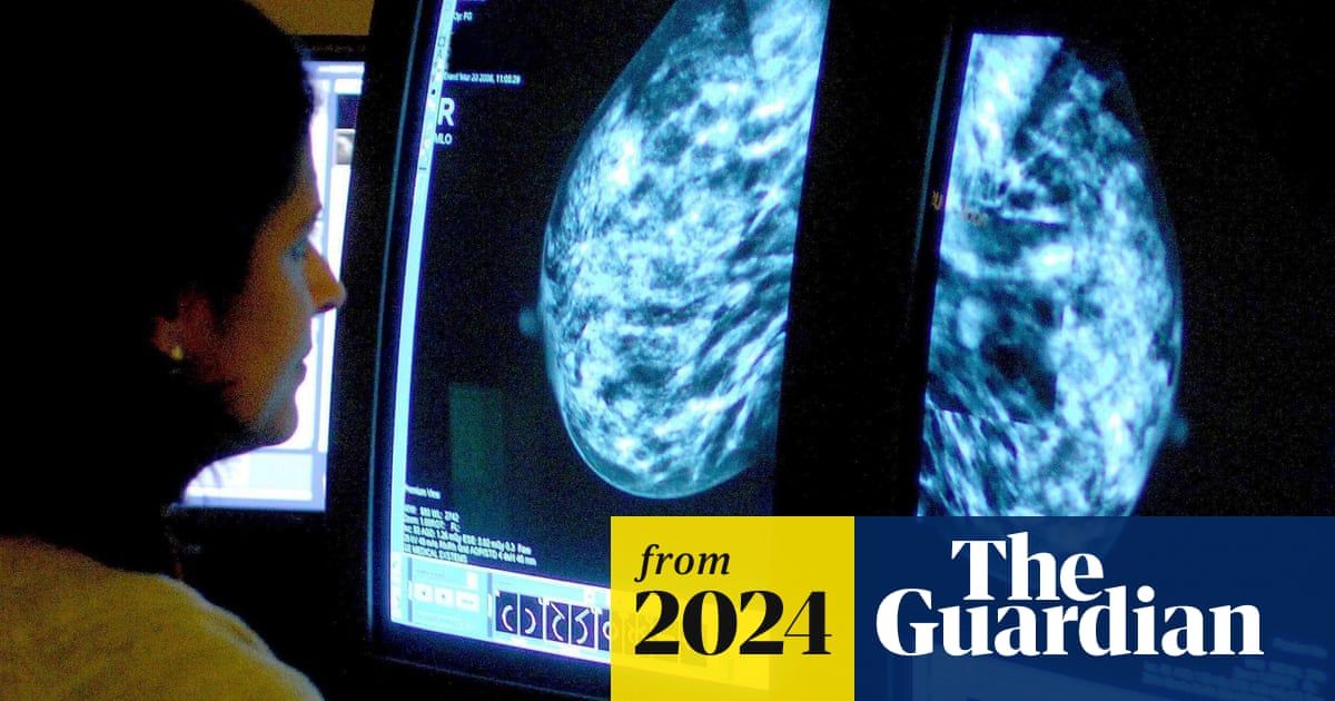 Medics design AI tool to predict side-effects in breast cancer patients