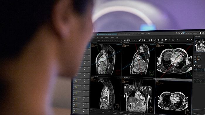 Philips advances Cardiac MR with a new suite of innovations powered by AI to expand patient access and improve diagnostic precision [1]