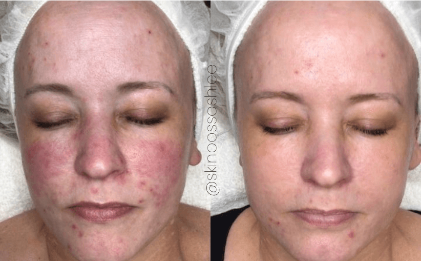Neo Elite® - Rosacea (6).png