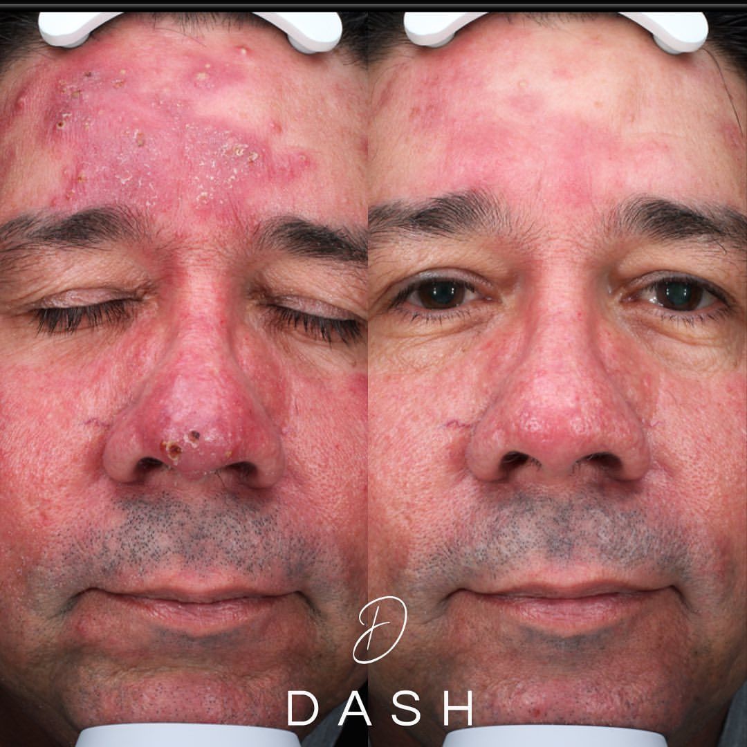 Neo Elite® - Rosacea.jpg