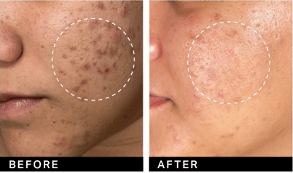 Individuele resultaten kunnen variëren. Deze persoon onderging zes Clarifying Hydrafacial-behandelingen. Foto’s met dank aan 'The Glow Aesthetics'.