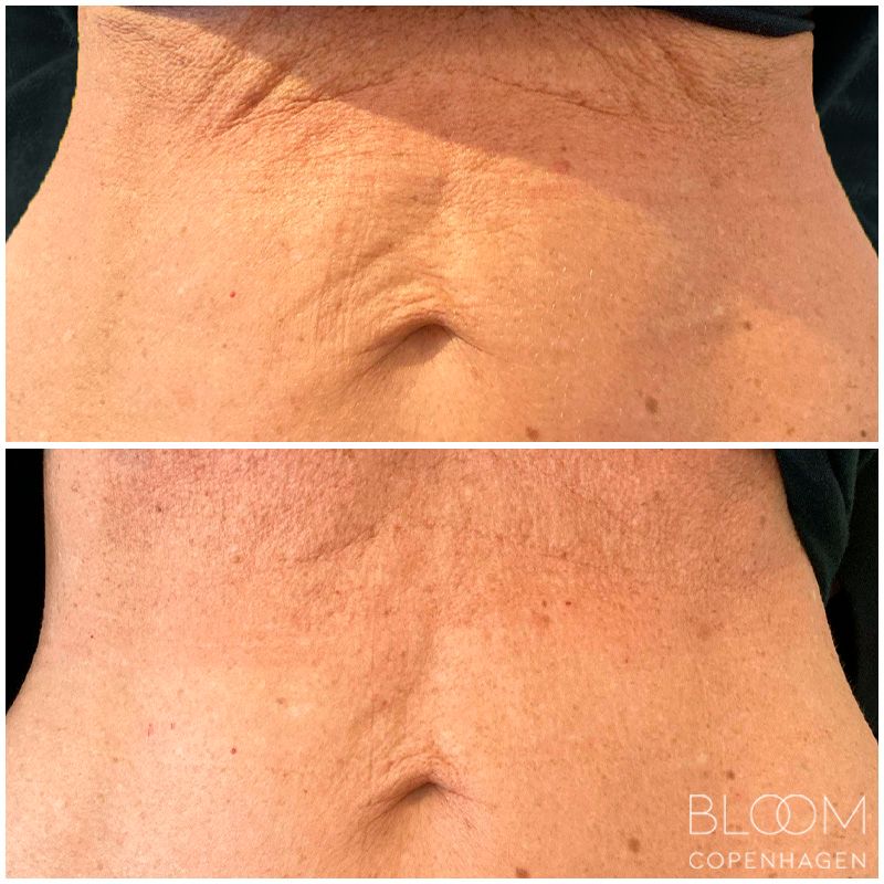 Sunekos Body - Stomach (Bloom) - Danemark (1).jpg