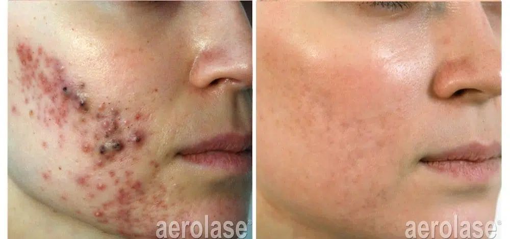 aerolase behandeling resultaat acne
