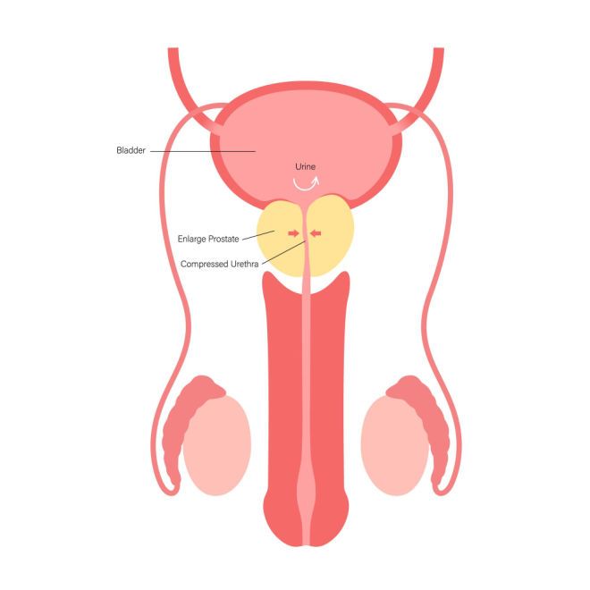 De vergrote prostaat (geel afgebeeld) beknelt en vernauwt de urinebuis
