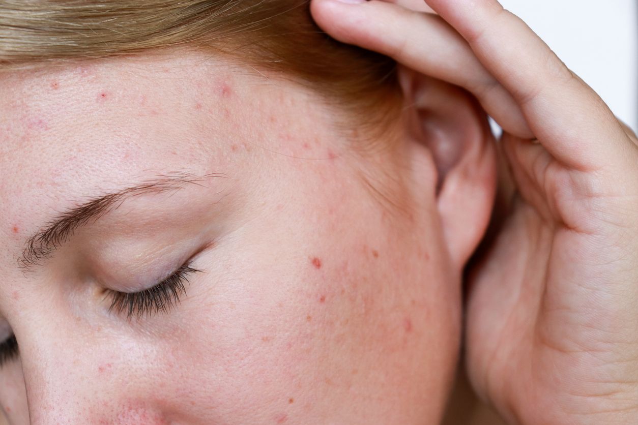 Acne behandelen zonder zware medicatie? Ontdek de kracht van Aerolase Neo Elite