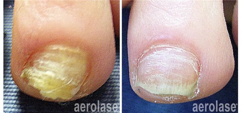aerolase behandeling resultaat voeten en nagels