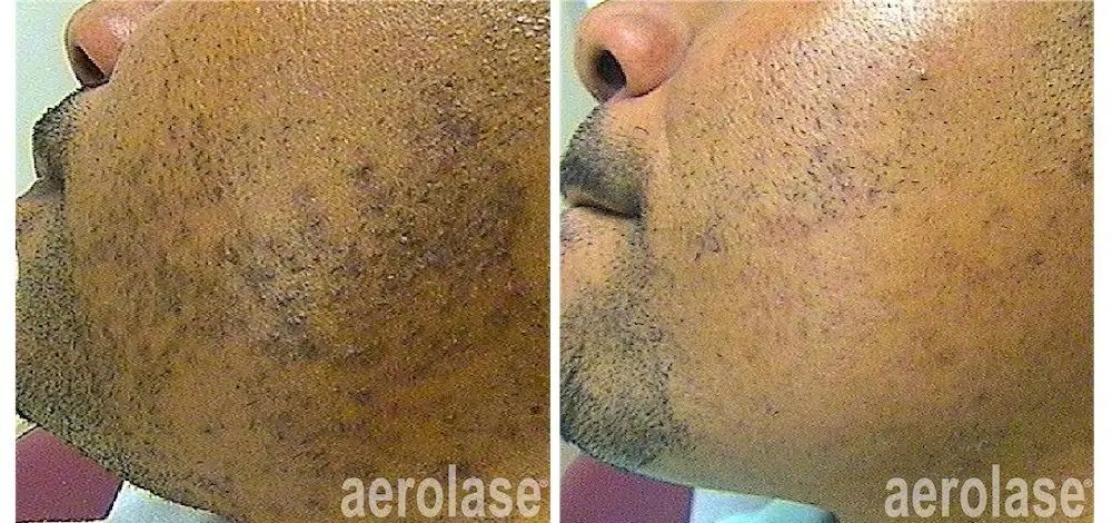 aerolase behandeling resultaat haarverwijdering en ingegroeide haren