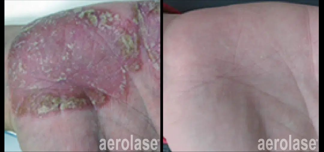 aerolase behandeling resultaat medische dermatologie