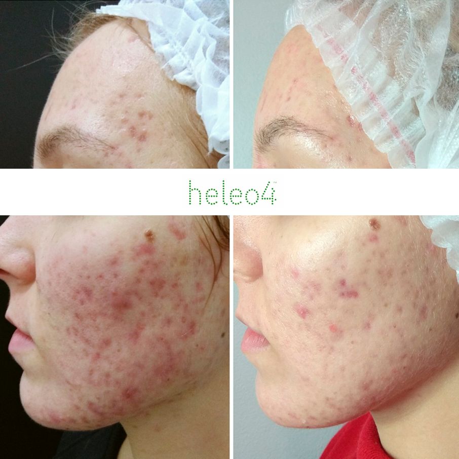 schoonheidsspecialiste met touch screen van hydra facial
